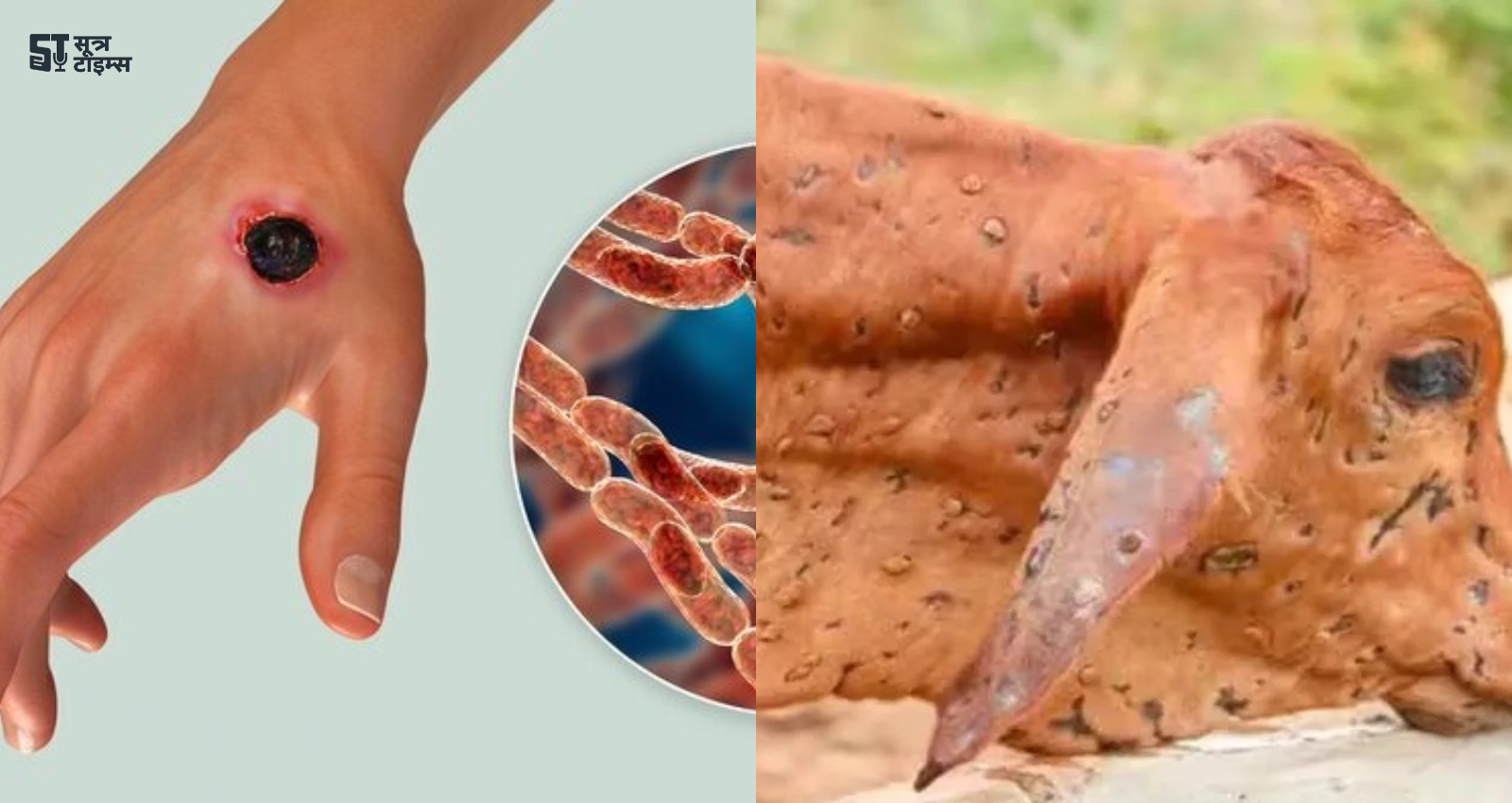Anthrax Disease
